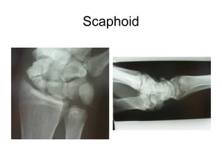 Scaphoid
 
