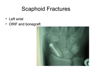 Scaphoid Fractures
• Left wrist
• ORIF and bonegraft
 