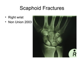 Scaphoid Fractures
• Right wrist
• Non Union 2003
 