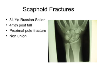 Scaphoid Fractures
• 34 Yo Russian Sailor
• 4mth post fall
• Proximal pole fracture
• Non union
 