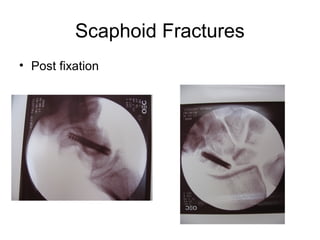 Scaphoid Fractures
• Post fixation
 