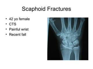 Scaphoid Fractures
• 42 yo female
• CTS
• Painful wrist
• Recent fall
 