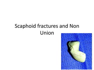 Scaphoid fractures and Non
Union
 