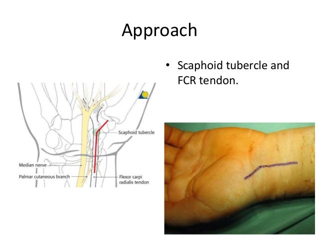 Scaphoid Fractures And Non Union
