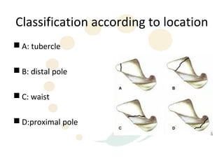 Classification according to location
 A: tubercle

 B: distal pole

 C: waist

 D:proximal pole
 