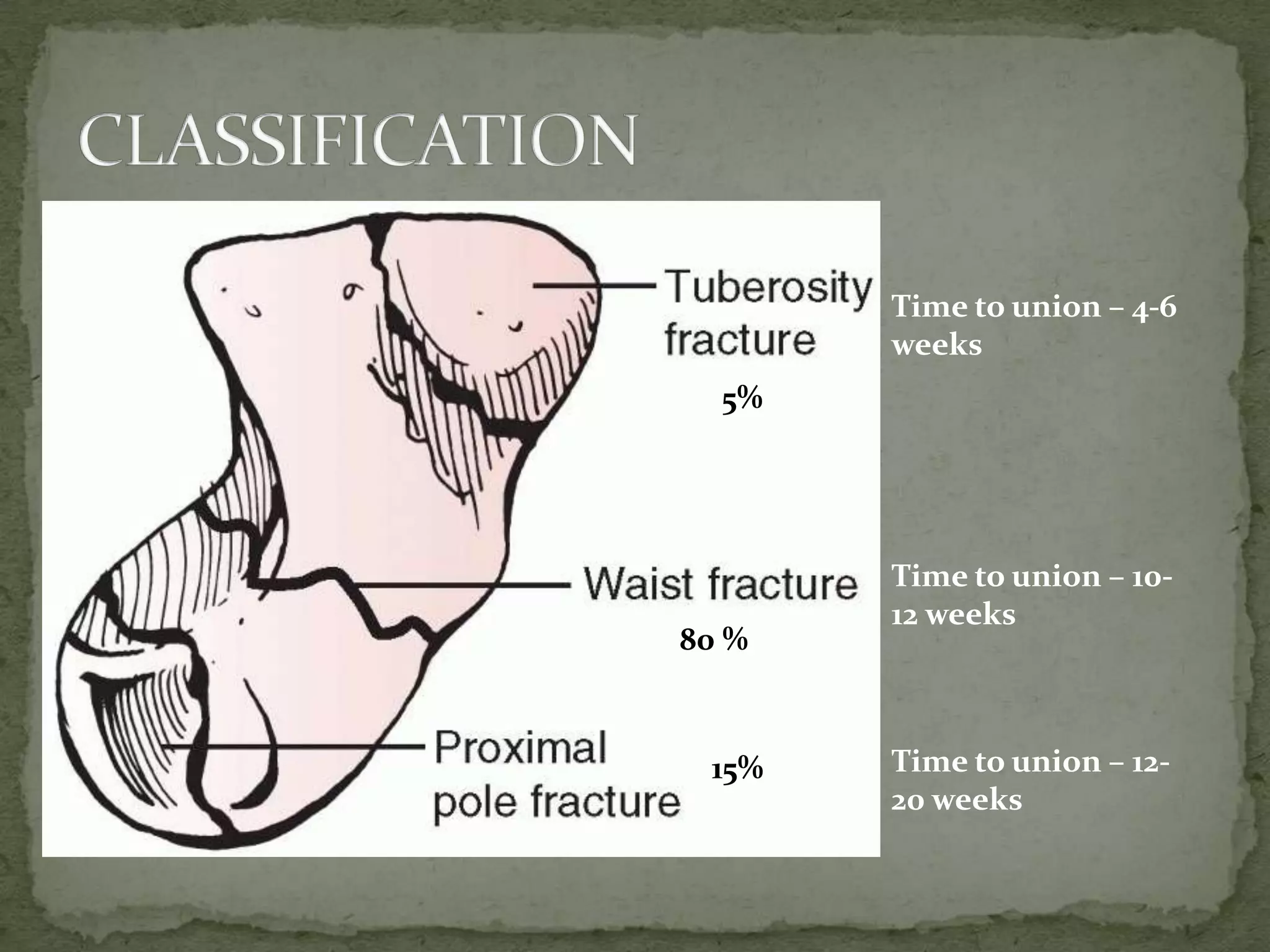 80 %
15%
5%
Time to union – 4-6
weeks
Time to union – 10-
12 weeks
Time to union – 12-
20 weeks
 