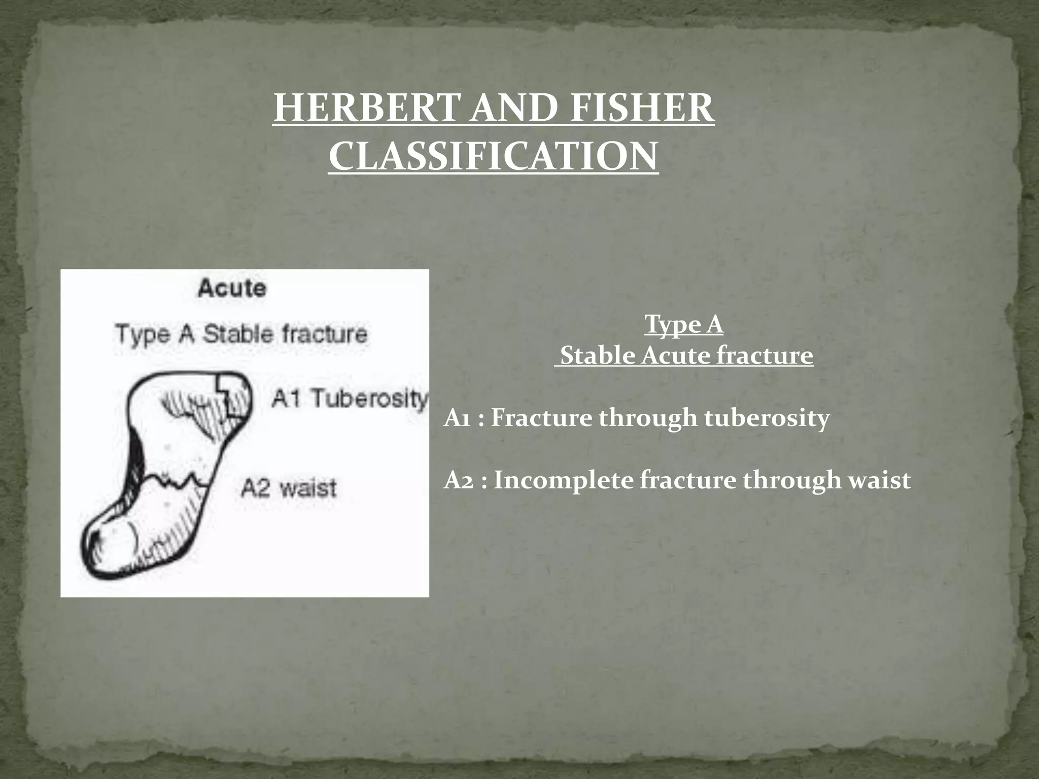 Type A
Stable Acute fracture
A1 : Fracture through tuberosity
A2 : Incomplete fracture through waist
HERBERT AND FISHER
CLASSIFICATION
 