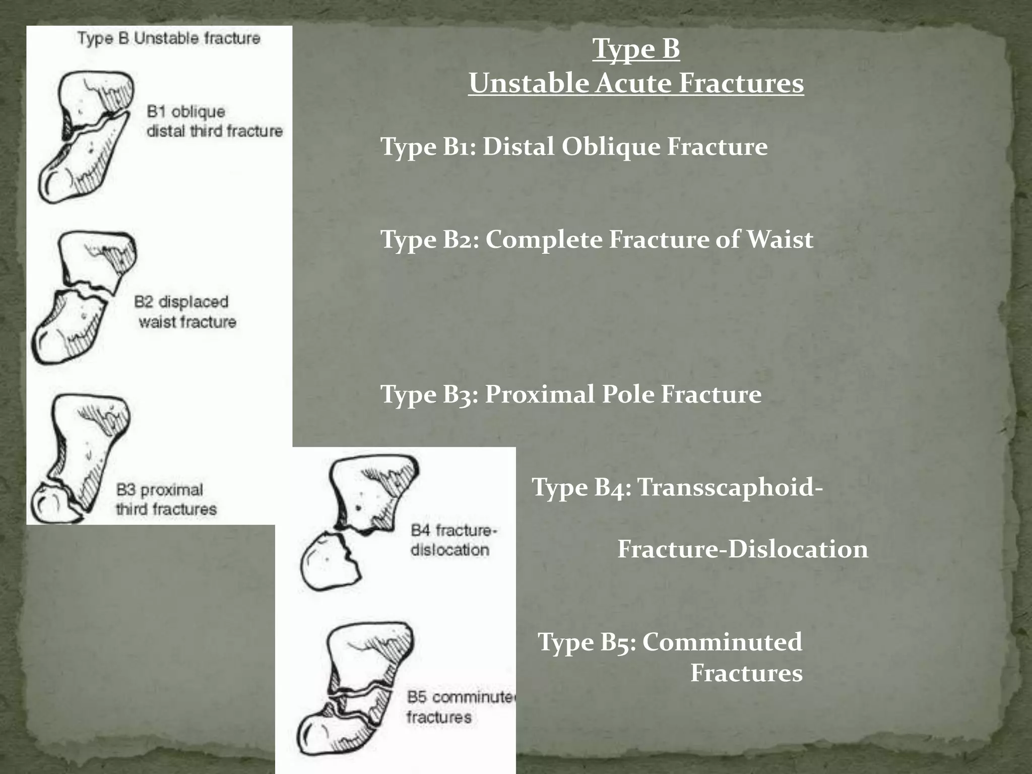 Type B
Unstable Acute Fractures
Type B1: Distal Oblique Fracture
Type B2: Complete Fracture of Waist
Type B3: Proximal Pole Fracture
Type B4: Transscaphoid-
Perilunate
Fracture-Dislocation
of Carpus
Type B5: Comminuted
Fractures
 