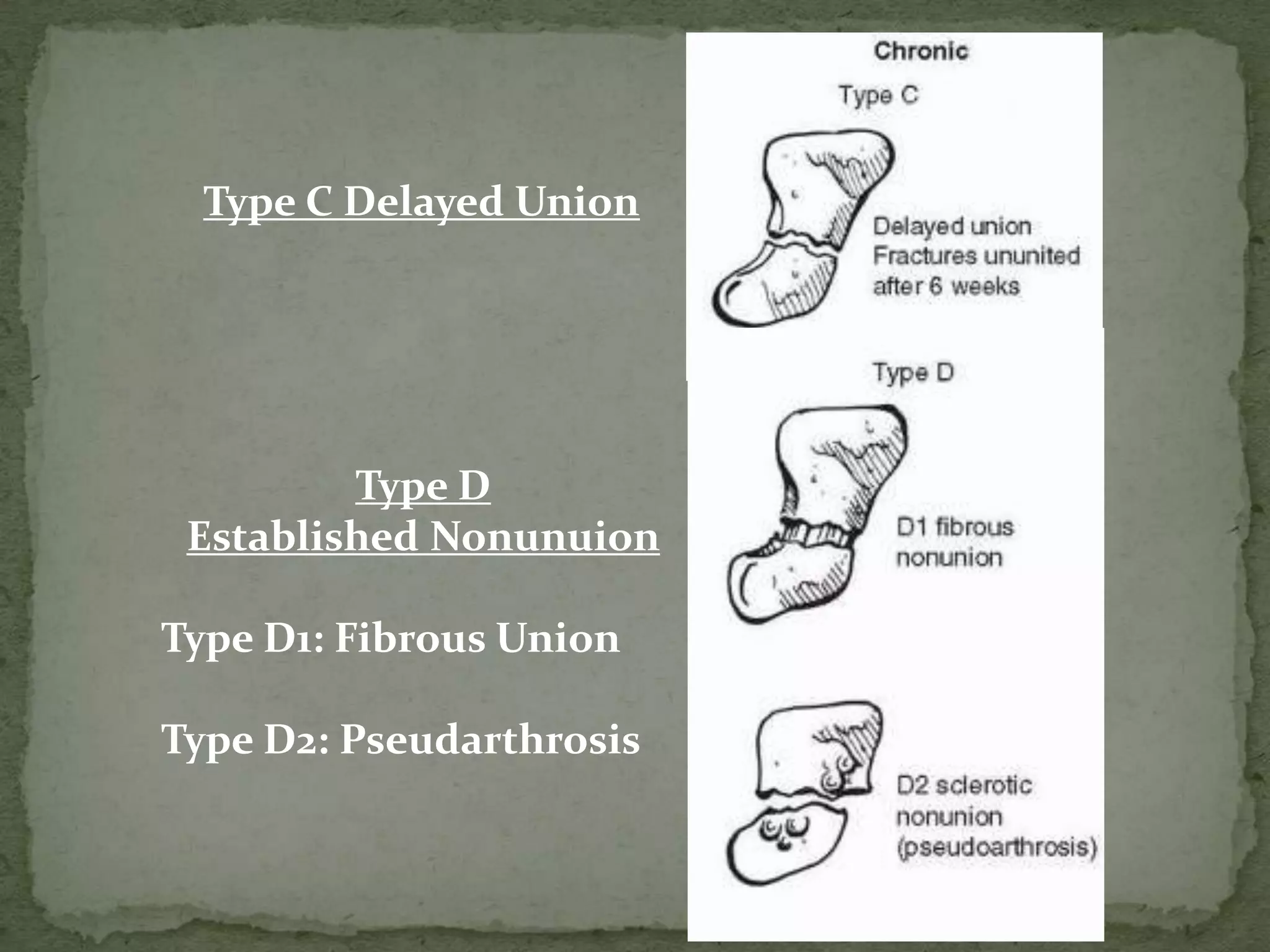 Type C Delayed Union
Type D
Established Nonunuion
Type D1: Fibrous Union
Type D2: Pseudarthrosis
 