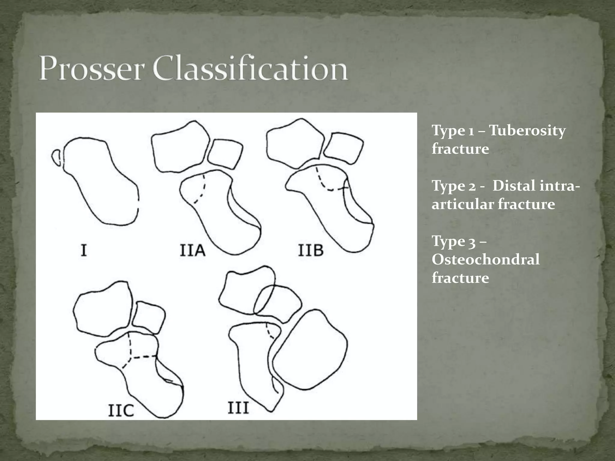 Type 1 – Tuberosity
fracture
Type 2 - Distal intra-
articular fracture
Type 3 –
Osteochondral
fracture
 
