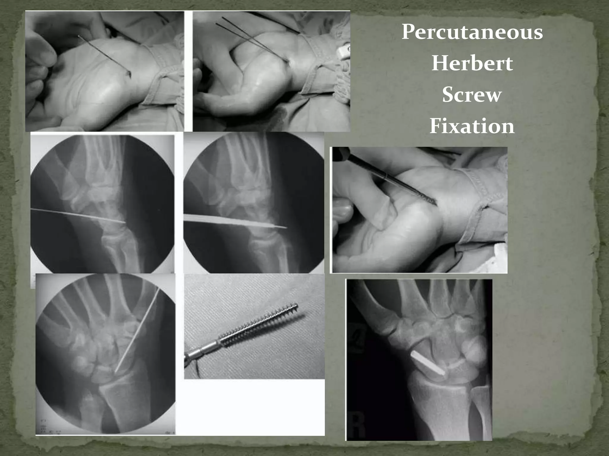 Percutaneous
Herbert
Screw
Fixation
 