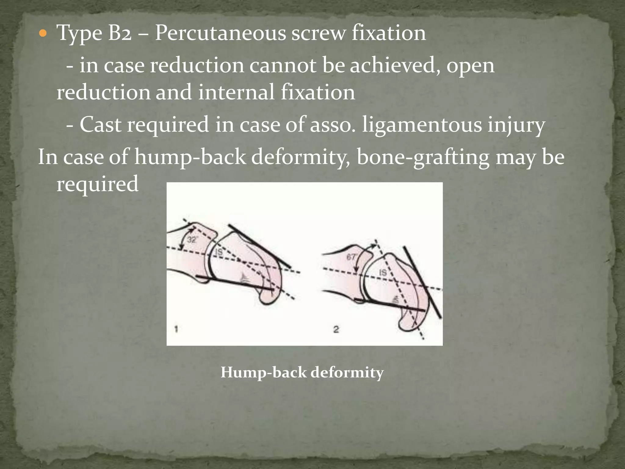  Type B2 – Percutaneous screw fixation
- in case reduction cannot be achieved, open
reduction and internal fixation
- Cast required in case of asso. ligamentous injury
In case of hump-back deformity, bone-grafting may be
required
Hump-back deformity
 