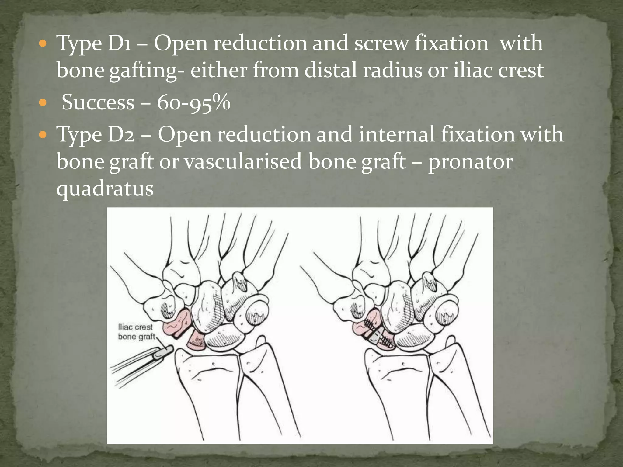  Type D1 – Open reduction and screw fixation with
bone gafting- either from distal radius or iliac crest
 Success – 60-95%
 Type D2 – Open reduction and internal fixation with
bone graft or vascularised bone graft – pronator
quadratus
 