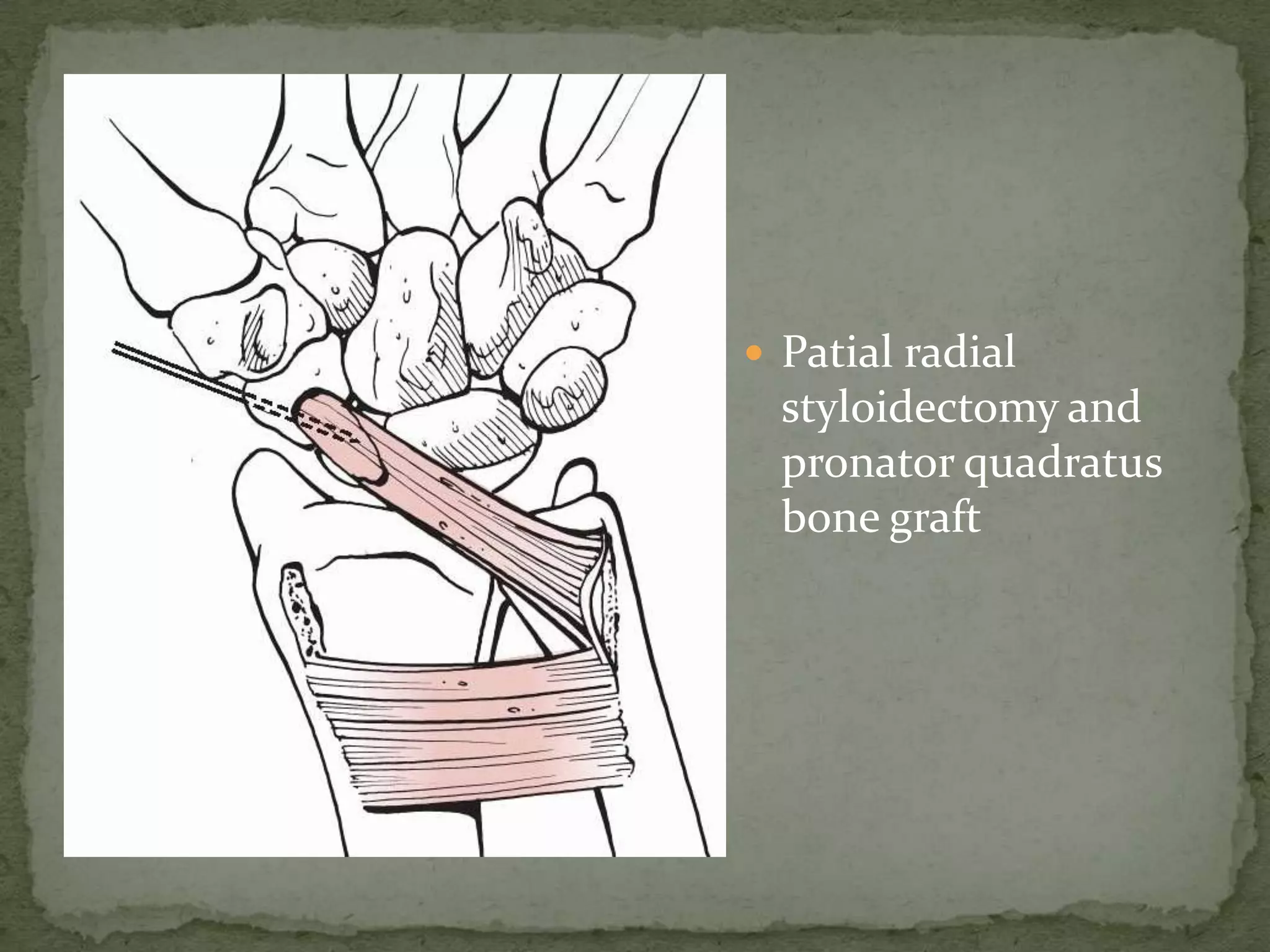  Patial radial
styloidectomy and
pronator quadratus
bone graft
 