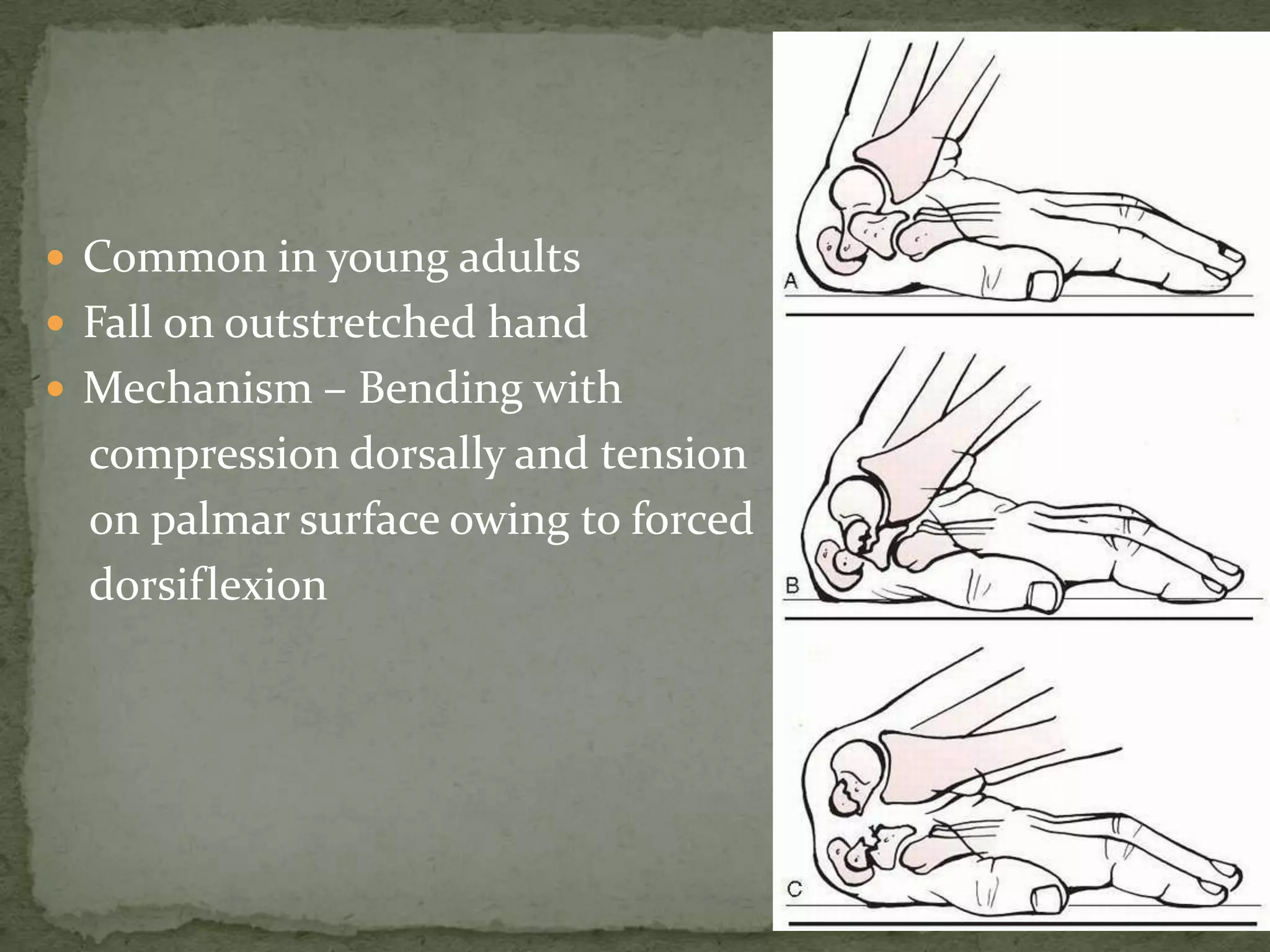  Common in young adults
 Fall on outstretched hand
 Mechanism – Bending with
compression dorsally and tension
on palmar surface owing to forced
dorsiflexion
 