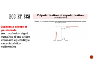 Onde T géante
(large et
symétrique)
Ischémie
transmurale
Anomalies
du QRS
Anomalies du
segment ST
ST+ « lésion sous-
épicardique »
« Séquelles de
nécrose »
Jours , mois voir
années
Ischémie sévère et
persistante
(ex. : occlusion aiguë
complète d’une artère
coronaire épicardique
sans circulation
collatérale)
 