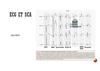 Cath lab
Thrombolyse
Quiz ECG
HVG BBG péricardite Hyper K BBD +
IDM
Brugada
 