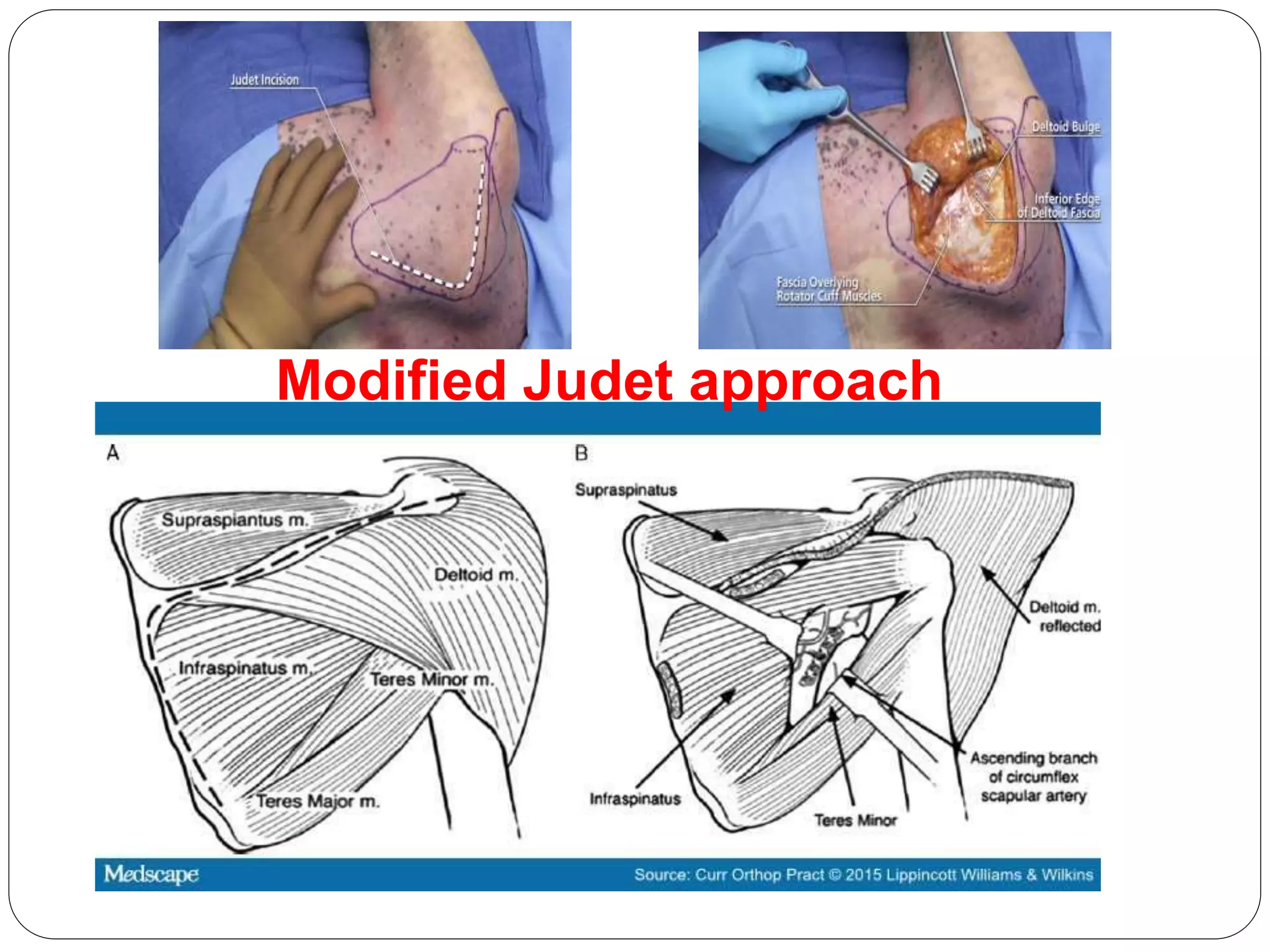 Modified Judet approach
 