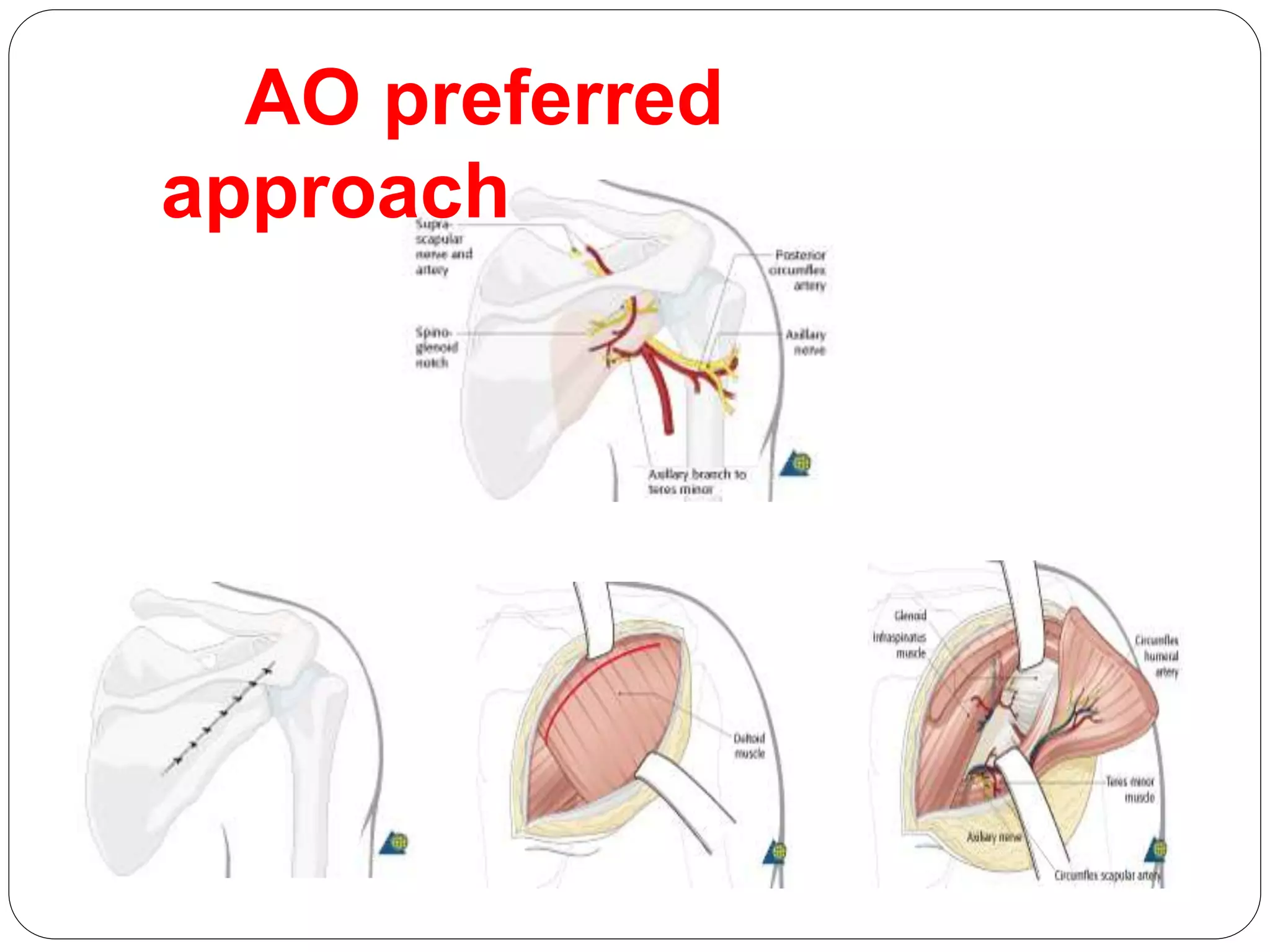 AO preferred
approach
 