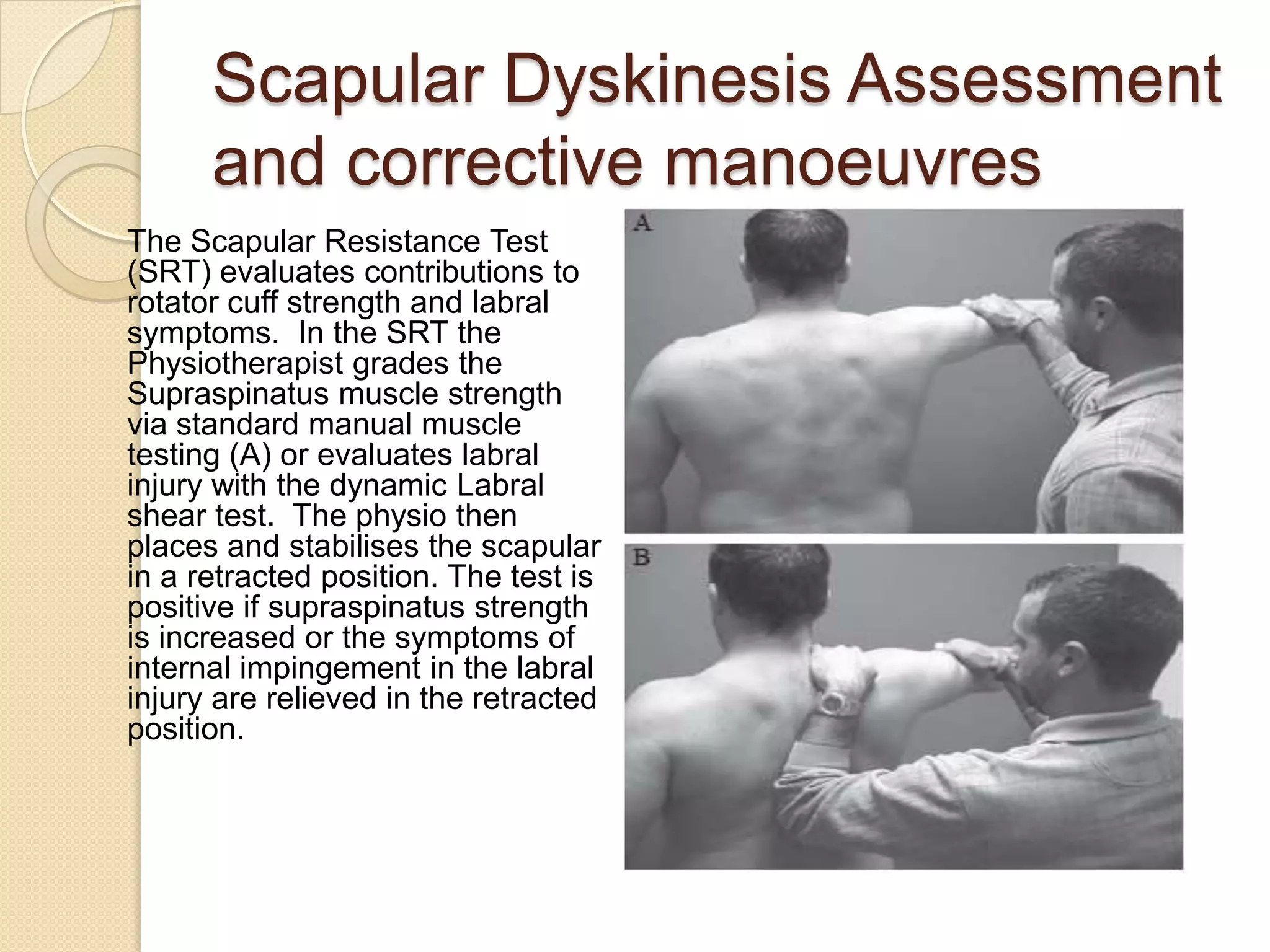 Scapular Dyskinesis Assessment
and corrective manoeuvres
The Scapular Resistance Test
(SRT) evaluates contributions to
rotator cuff strength and labral
symptoms. In the SRT the
Physiotherapist grades the
Supraspinatus muscle strength
via standard manual muscle
testing (A) or evaluates labral
injury with the dynamic Labral
shear test. The physio then
places and stabilises the scapular
in a retracted position. The test is
positive if supraspinatus strength
is increased or the symptoms of
internal impingement in the labral
injury are relieved in the retracted
position.
 