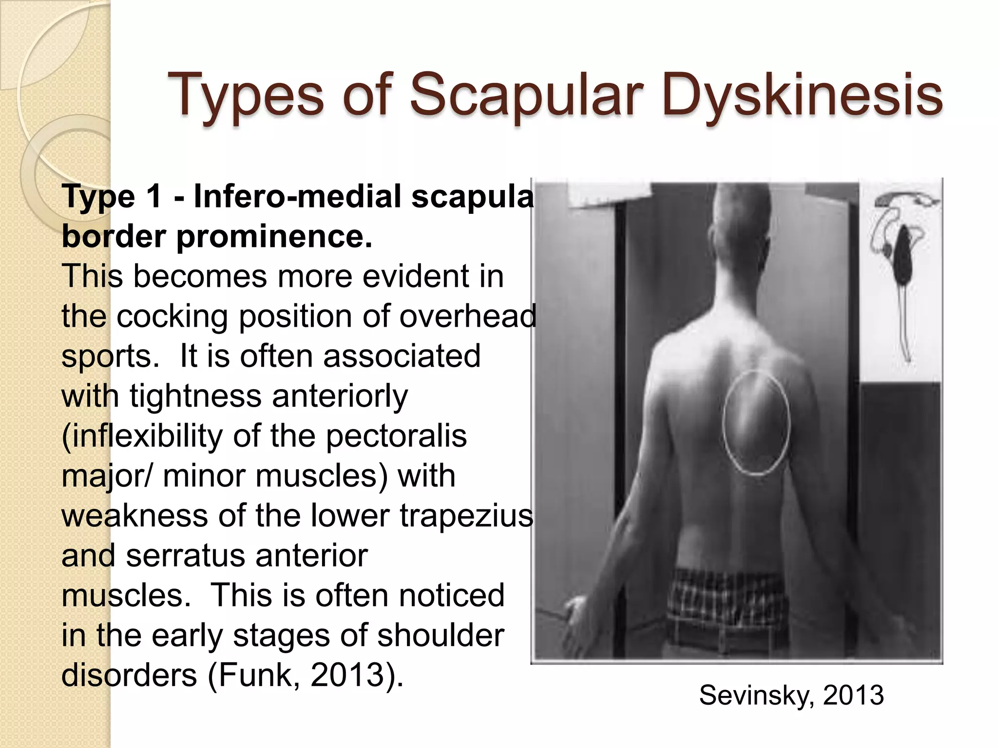 Types of Scapular Dyskinesis
Type 1 - Infero-medial scapula
border prominence.
This becomes more evident in
the cocking position of overhead
sports. It is often associated
with tightness anteriorly
(inflexibility of the pectoralis
major/ minor muscles) with
weakness of the lower trapezius
and serratus anterior
muscles. This is often noticed
in the early stages of shoulder
disorders (Funk, 2013).
Sevinsky, 2013
 