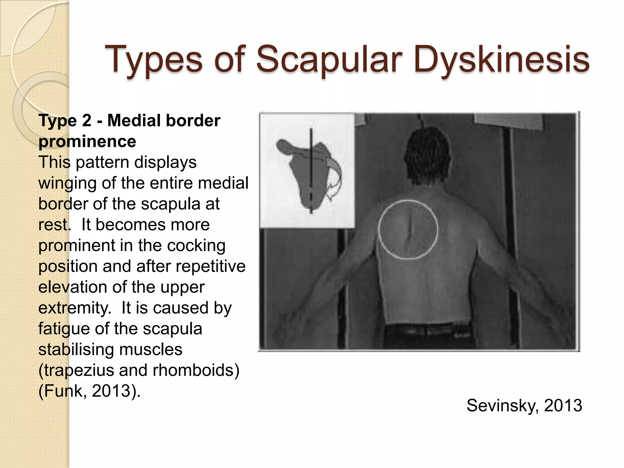 Types of Scapular Dyskinesis
Type 2 - Medial border
prominence
This pattern displays
winging of the entire medial
border of the scapula at
rest. It becomes more
prominent in the cocking
position and after repetitive
elevation of the upper
extremity. It is caused by
fatigue of the scapula
stabilising muscles
(trapezius and rhomboids)
(Funk, 2013).
Sevinsky, 2013
 