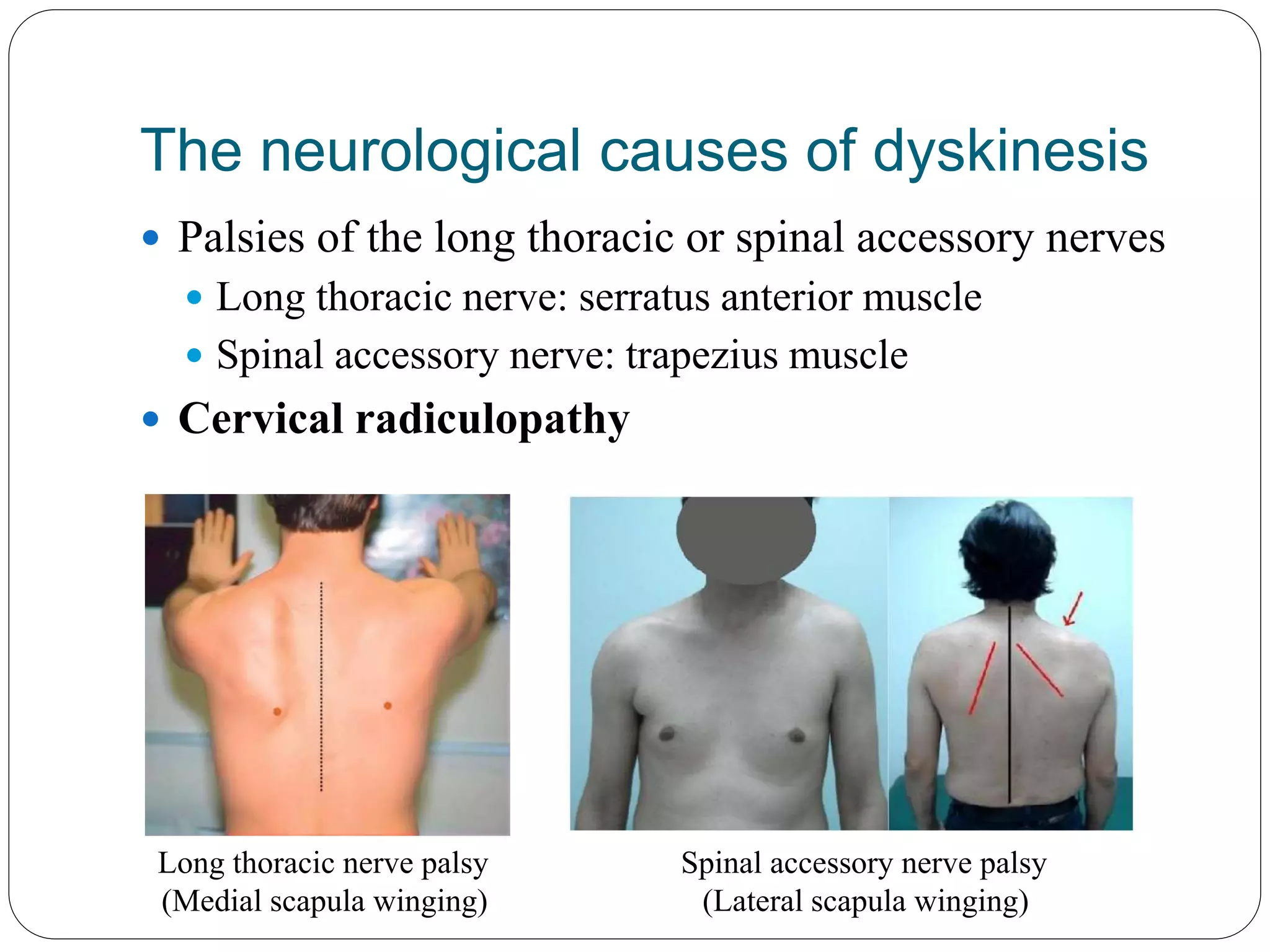 Scapular dyskinesis | PPT