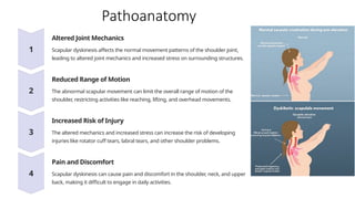 Pathoanatomy
Altered Joint Mechanics
Scapular dyskinesis affects the normal movement patterns of the shoulder joint,
leading to altered joint mechanics and increased stress on surrounding structures.
Reduced Range of Motion
The abnormal scapular movement can limit the overall range of motion of the
shoulder, restricting activities like reaching, lifting, and overhead movements.
Increased Risk of Injury
The altered mechanics and increased stress can increase the risk of developing
injuries like rotator cuff tears, labral tears, and other shoulder problems.
Pain and Discomfort
Scapular dyskinesis can cause pain and discomfort in the shoulder, neck, and upper
back, making it difficult to engage in daily activities.
 