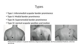 Types
• Type I: inferomedial scapular border prominence
• Type II: Medial border prominence
• Type III: Superomedial border prominence
• Type IV: normal scapular position and motion
Postacchini R, Carbone S. Scapular dyskinesis: diagnosis and treatment. OA Musculoskeletal Medicine. 2013 Oct
18;1(2):20.
 