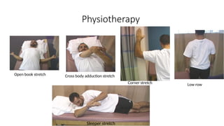Physiotherapy
Open book stretch Cross body adduction stretch
Corner stretch Low row
Sleeper stretch
 