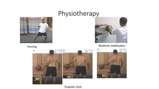 Physiotherapy
Fencing Rhythmic stabilization
Scapular clock
 