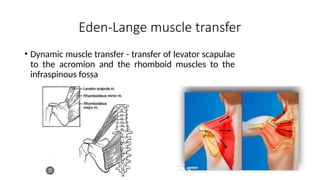 Eden-Lange muscle transfer
• Dynamic muscle transfer - transfer of levator scapulae
to the acromion and the rhomboid muscles to the
infraspinous fossa
 