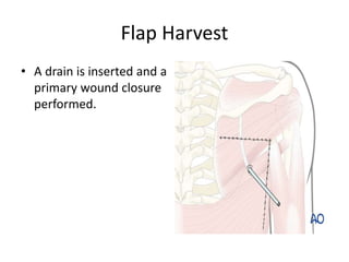 Flap Harvest
• A drain is inserted and a
primary wound closure
performed.
 