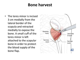 Bone harvest
• The teres minor is incised
3 cm medially from the
lateral border of the
scapula and retracted
medially to expose the
bone. A small cuff of the
teres minor is left
attached to the scapular
bone in order to protect
the blood supply of the
bone flap.
 