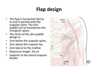 Flap design
• The flap is harvested inferior
to and in parallel with the
scapular spine. The skin
paddle has to incorporate the
triangular space.
• The limits of the skin paddle
design is:
• 2cm below the scapular spine,
• 2cm above the scapular tip,
• 2cm lateral to the midline
• Maximum length: 24 cm
• Superior to the lateral scapular
border
 