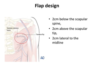 Flap design
• 2cm below the scapular
spine,
• 2cm above the scapular
tip,
• 2cm lateral to the
midline
 