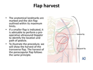 Flap harvest
• The anatomical landmarks are
marked and the skin flap
outlined within its maximum
limits.
• If a smaller flap is indicated, it
is advisable to perform a pre-
operative ultrasound Doppler
to identify the location and
path of pedicle.
• To illustrate the procedure, we
will show the harvest of the
transverse flap. The harvest of
the parascapular flap follows
the same principle.
 