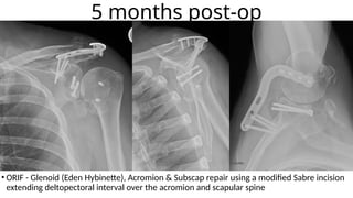 Scapular FracturesDJKLKLKLAJJFJJJJJJJJJJ | PPTX