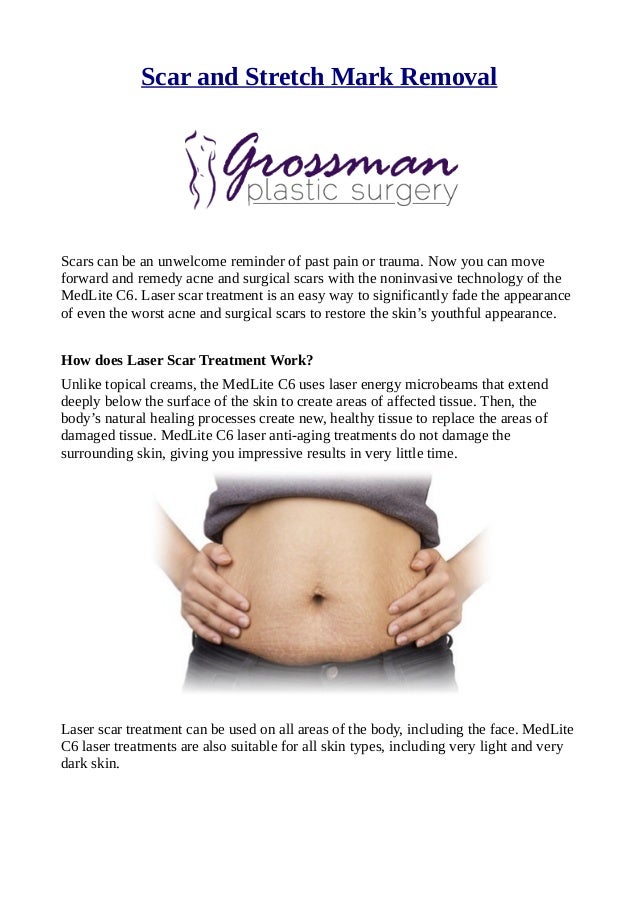 topical cream for stretch marks