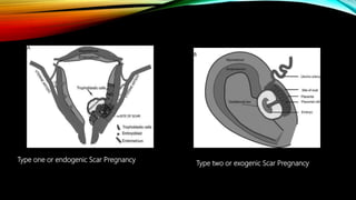 Type one or endogenic Scar Pregnancy
Type two or exogenic Scar Pregnancy
 