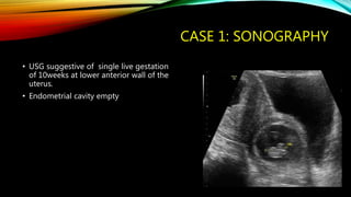 CASE 1: SONOGRAPHY
• USG suggestive of single live gestation
of 10weeks at lower anterior wall of the
uterus.
• Endometrial cavity empty
 