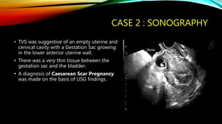 CASE 2 : SONOGRAPHY
• TVS was suggestive of an empty uterine and
cervical cavity with a Gestation Sac growing
in the lower anterior uterine wall.
• There was a very thin tissue between the
gestation sac and the bladder.
• A diagnosis of Caesarean Scar Pregnancy
was made on the basis of USG findings.
 