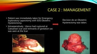 CASE 2 : MANAGEMENT
• Patient was immediately taken for Emergency
Exploratory Laparotomy with SOS Obstetric
Hysterectomy.
• Intraoperatively : Uterus had ruptured at
Caesarean scar and remnants of gestation sac
was seen at the Scar
Decision do an Obstetric
Hysterectomy was taken.
 