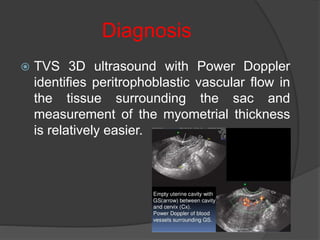 Diagnosis
 TVS 3D ultrasound with Power Doppler
identifies peritrophoblastic vascular flow in
the tissue surrounding the sac and
measurement of the myometrial thickness
is relatively easier.
 