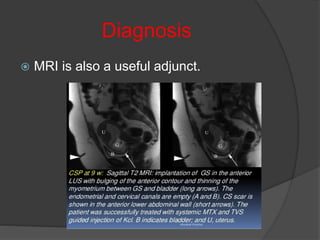 Diagnosis
 MRI is also a useful adjunct.
 
