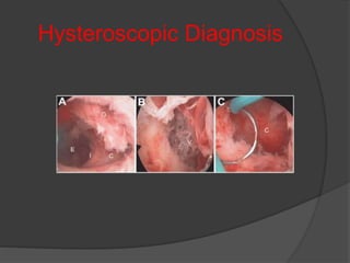Hysteroscopic Diagnosis
 
