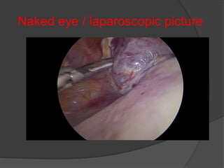 Naked eye / laparoscopic picture
 