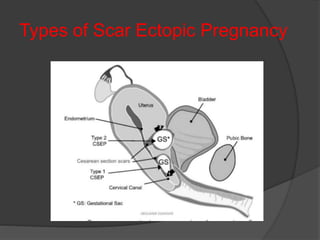 Types of Scar Ectopic Pregnancy
 