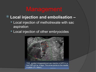 Management
 Local injection and embolisation –
 Local injection of methotrexate with sac
aspiration
 Local injection of other embryocides
 