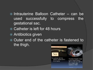  Intrauterine Balloon Catheter – can be
used successfully to compress the
gestational sac.
 Catheter is left for 48 hours
 Antibiotics given
 Outer end of the catheter is fastened to
the thigh.
 